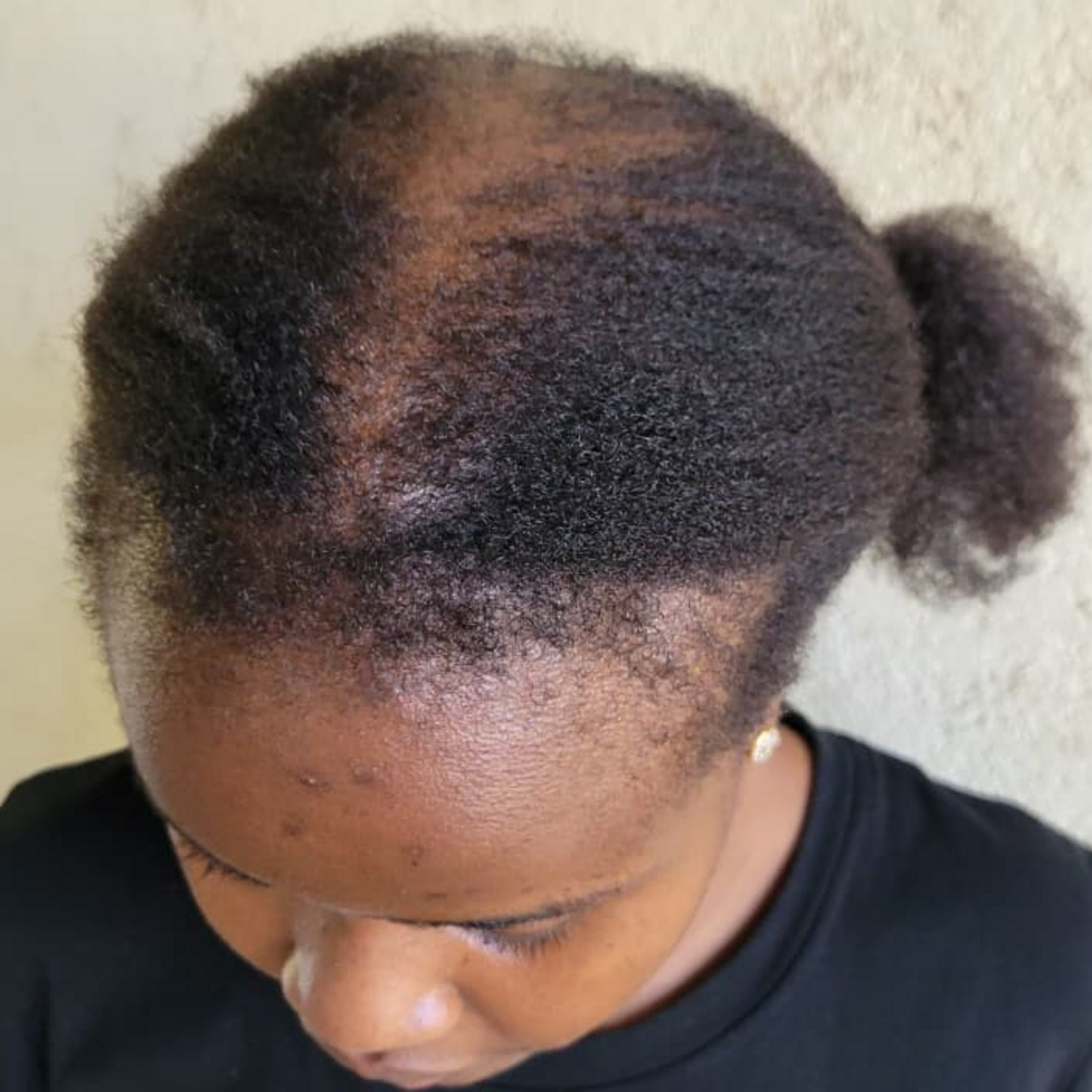 “I’m 23 and losing my hair”